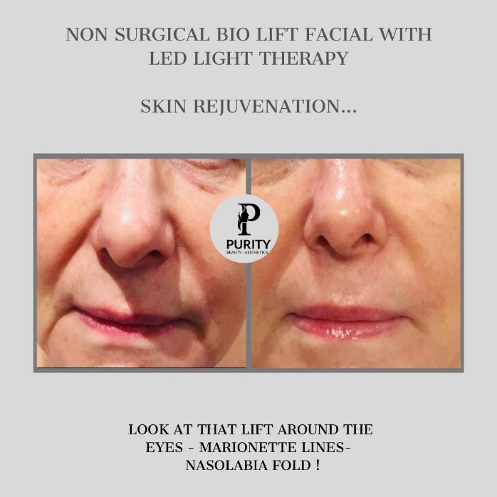 Non Surgical Bio Lift Facial With LED Light Therapy - Skin Rejuvenation