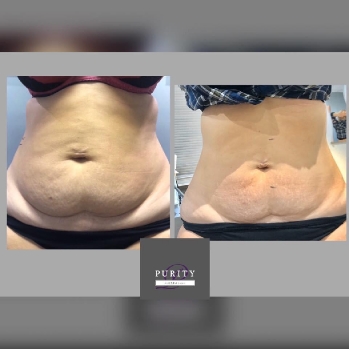 3D Lipo Fat Freezing