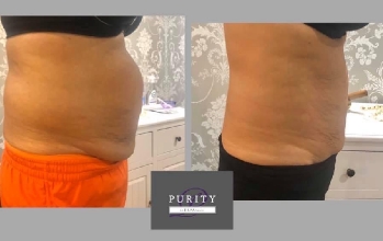 Fat Freezing Treatment Hampshire