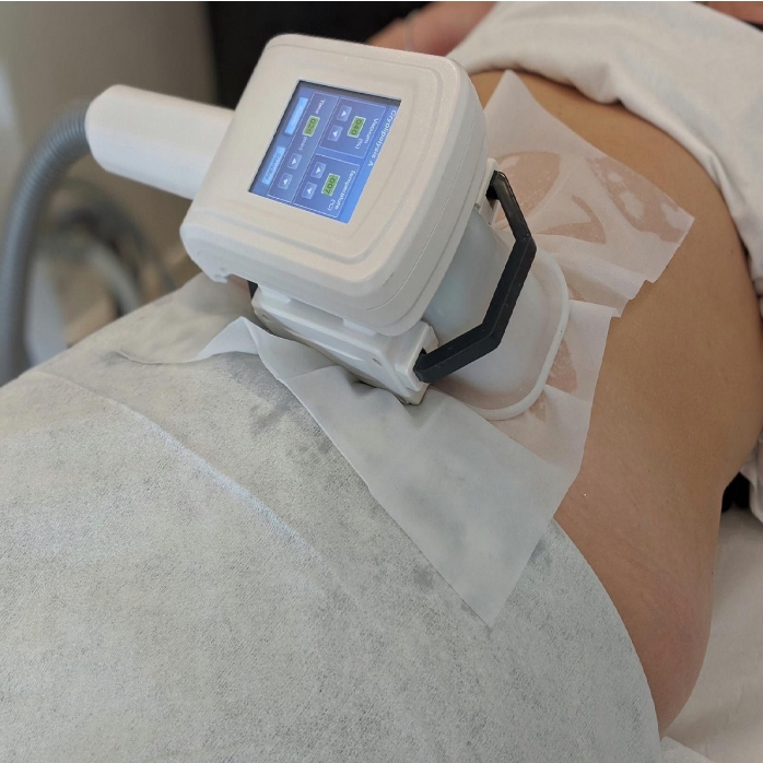 3D Cryolopolysis