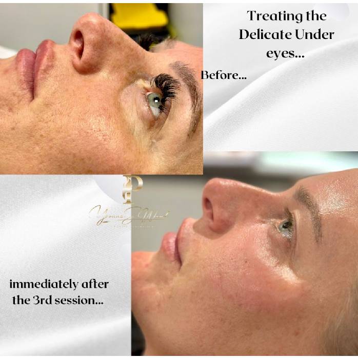 Eye Rejuvenation One