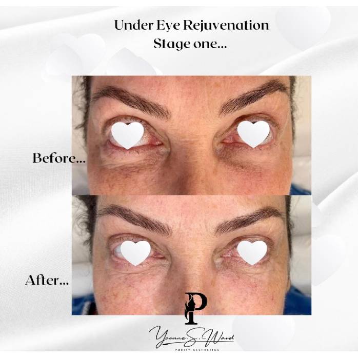 Eye Rejuvenation Two