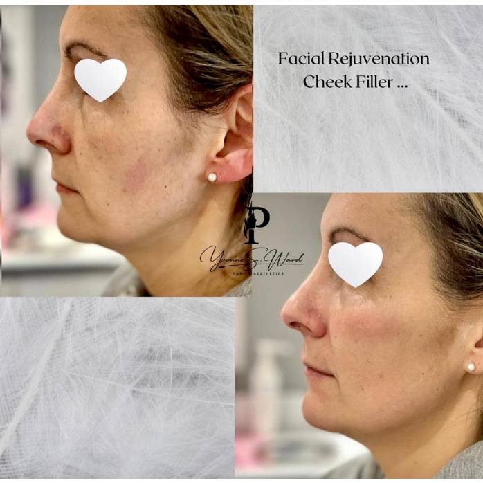 Dermal Filler Four