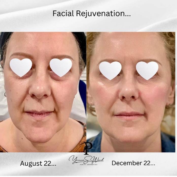 Dermal Filler Before & After