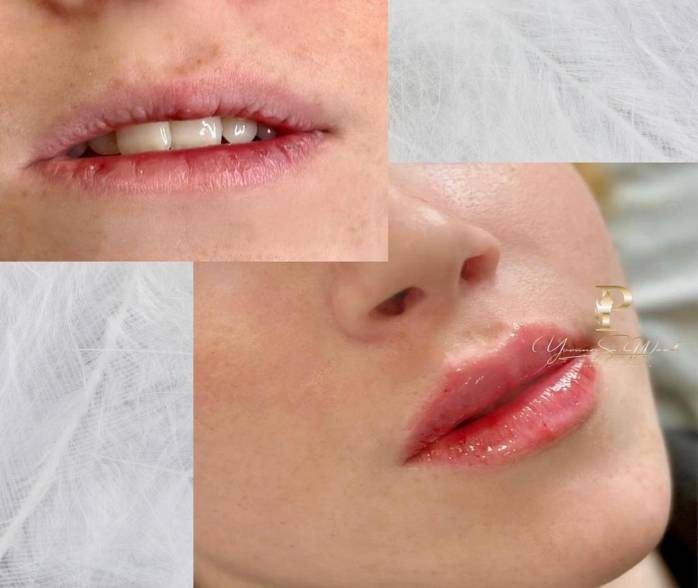 Dermal Filler Five