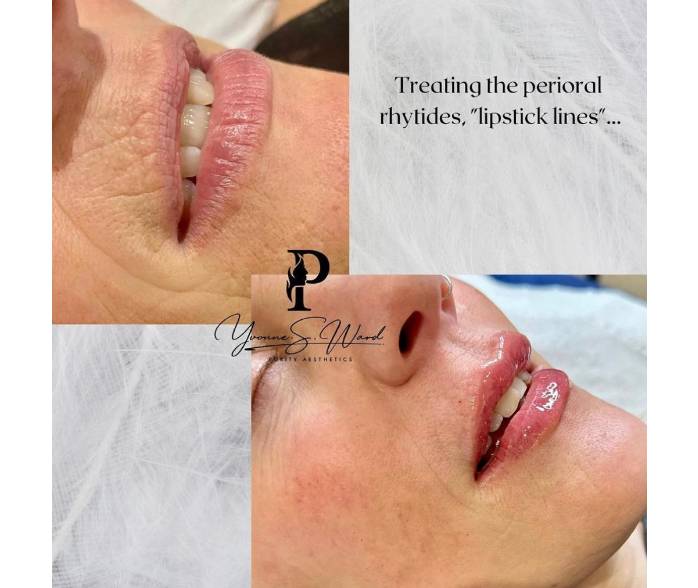 Dermal Filler Five