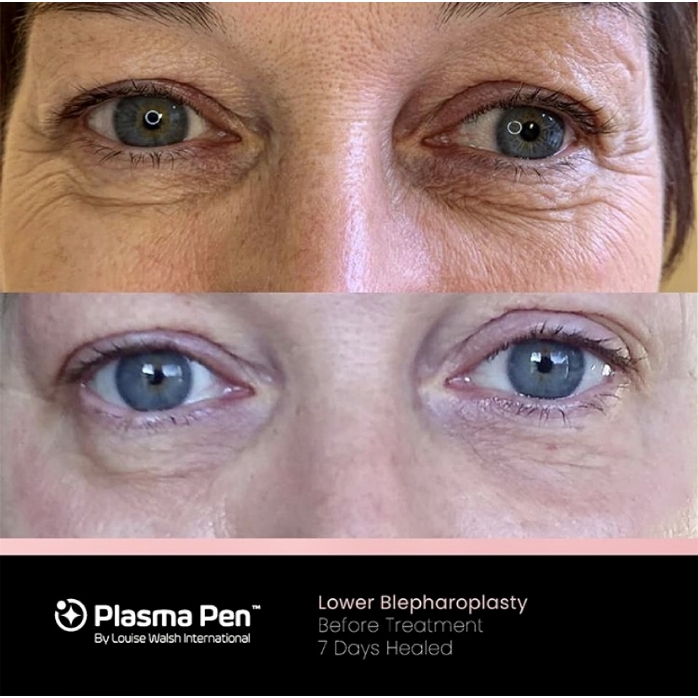 Plasma Pen Lower Blepharoplasty Before Treatment 7 Days Healed