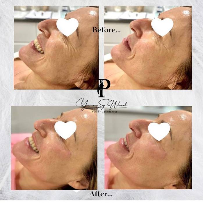 Dermal Filler Four